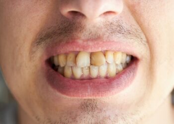 हंसते हुए झलकता है दांतों का पीलापन, तो इस फल के छिलके को 4 मिनट रगड़ें, सात दिन में सफेद हो जाएंगे दांत